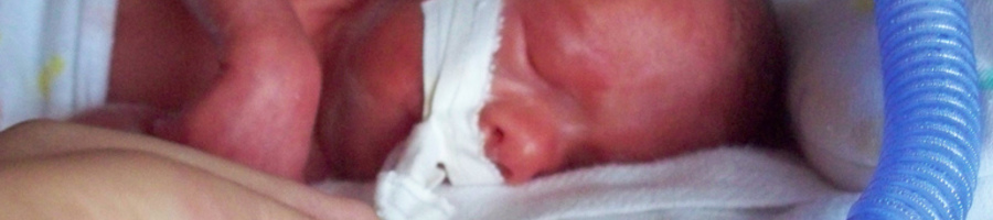 Premature Infant With Ventilator